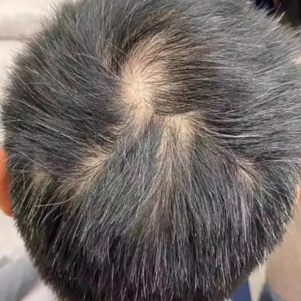 HairsKing™ – Κρέμα Μαλλιών για Άμεση Πυκνότητα